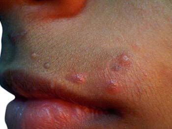 Introduction of Molluscum Contagiosum